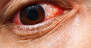 Alergie očí: 10 Osvědčených tipů jak zmírnit symptomy!