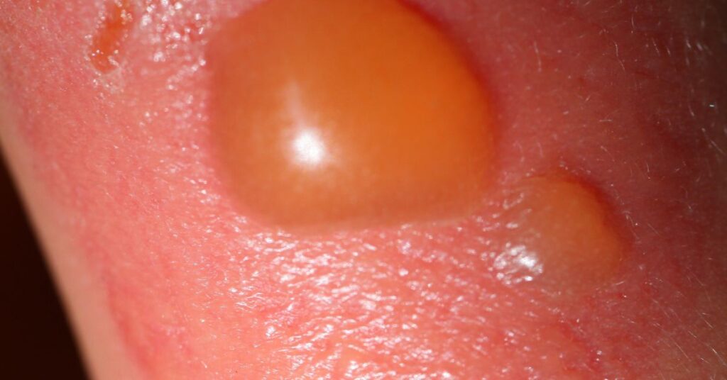 Babské rady na popáleniny: 17 Tipů jak si pomoci při popálení doma 2 a severe first-degree burn on skin showing redness, slight swelling, and exposed tissue near the mouth area from contact with horká voda or chemikálie