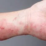 Senior Hub - Svět Pomůcek Pro Život Bez Bolesti A Limitací! 32 Babské rady na svrab: 17 Nejlepších domácích léků, které vás zachrání